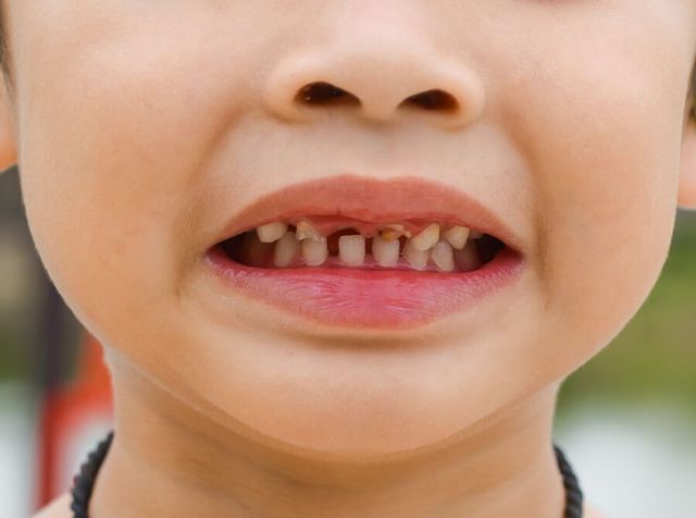 Гнилые зубы: причины, лечение и возможные последствия